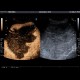 Liver hemangioma, huge, CEUS: US - Ultrasound